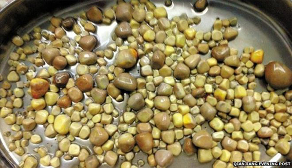 China: Doctors remove 420 kidney stones from patient